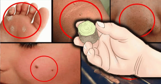 Remove Warts, Blackheads And Age Spots Naturally