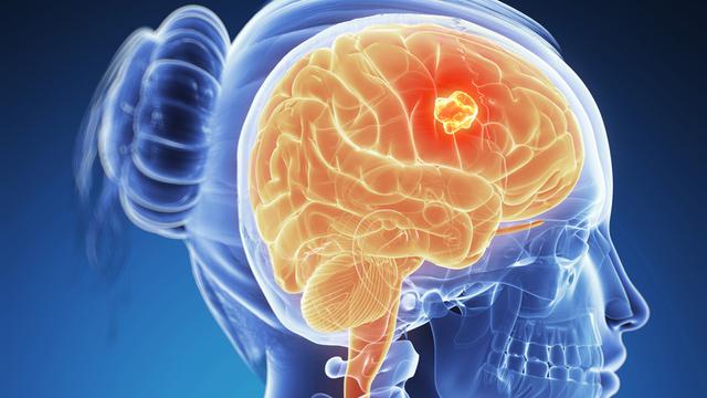 Gejala Kanker Otak dan Rangkaian Tes Kanker Otak