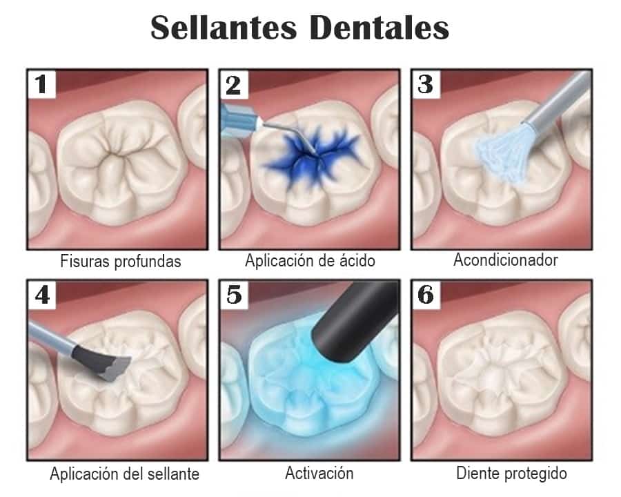Selladores de fosetas y fisuras