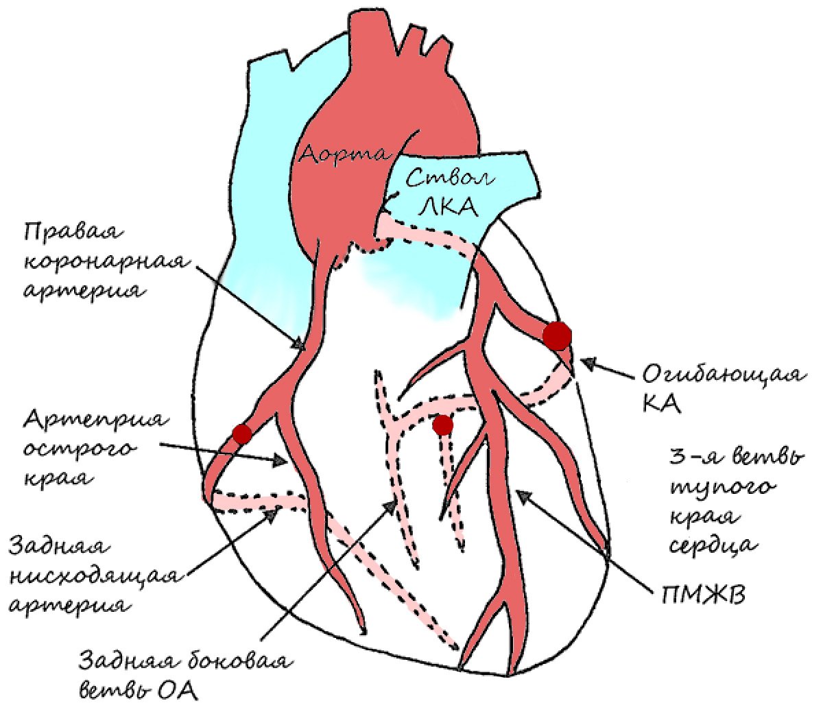строение коронарных артерий. типы диссекция коронарной артерии. пмжв. пмжв сердца артерия. что такое стентирование пмжв лка.