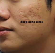how long does acne scars take to go away