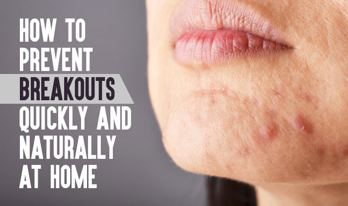 How To Prevent Breakouts Quickly and Naturally At Home