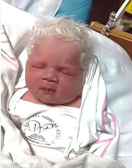 bukan albinisme, Bayi ini kurang pigmen - liataja.com