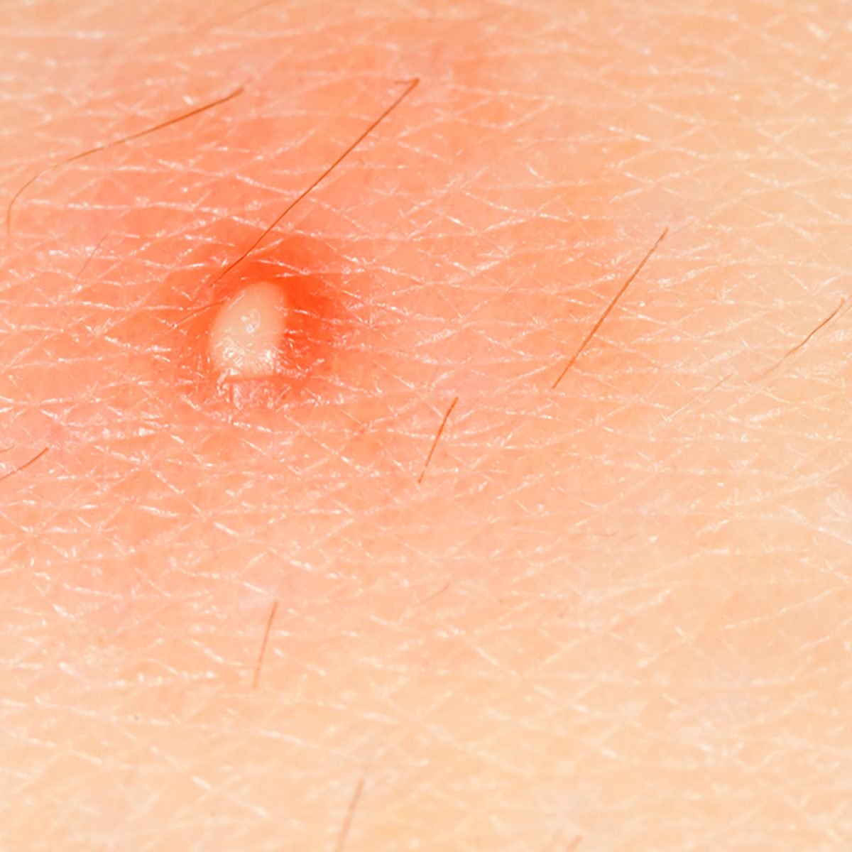 bikini bolgesinde sivilce neden cikar