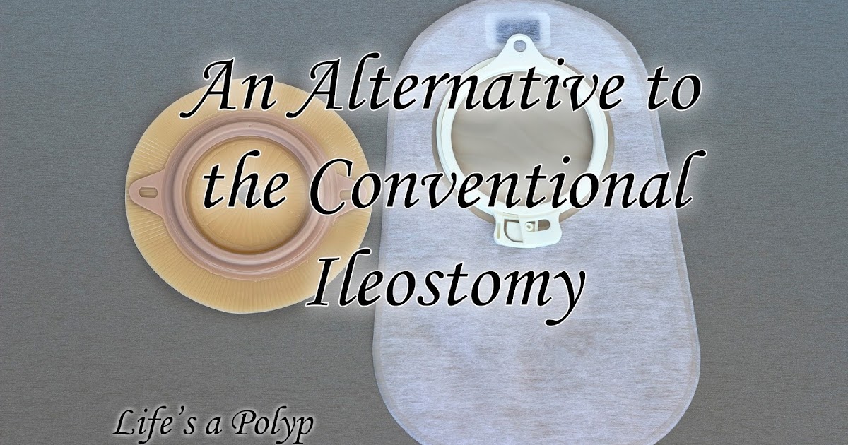 Life's a Polyp : Continent Ileostomies
