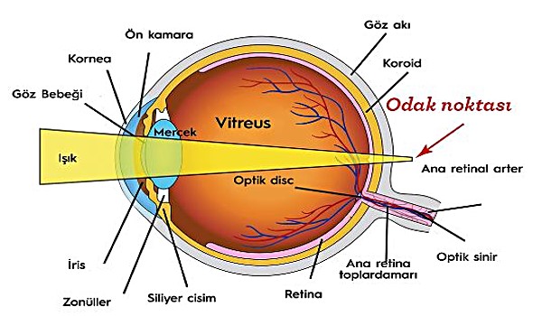 hipermetrop goz kusuru nedir neden olur hangi mercekle duzeltilir big bilgi