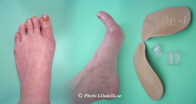 hallux valgus, halluxvalgus-operation, skoinlägg