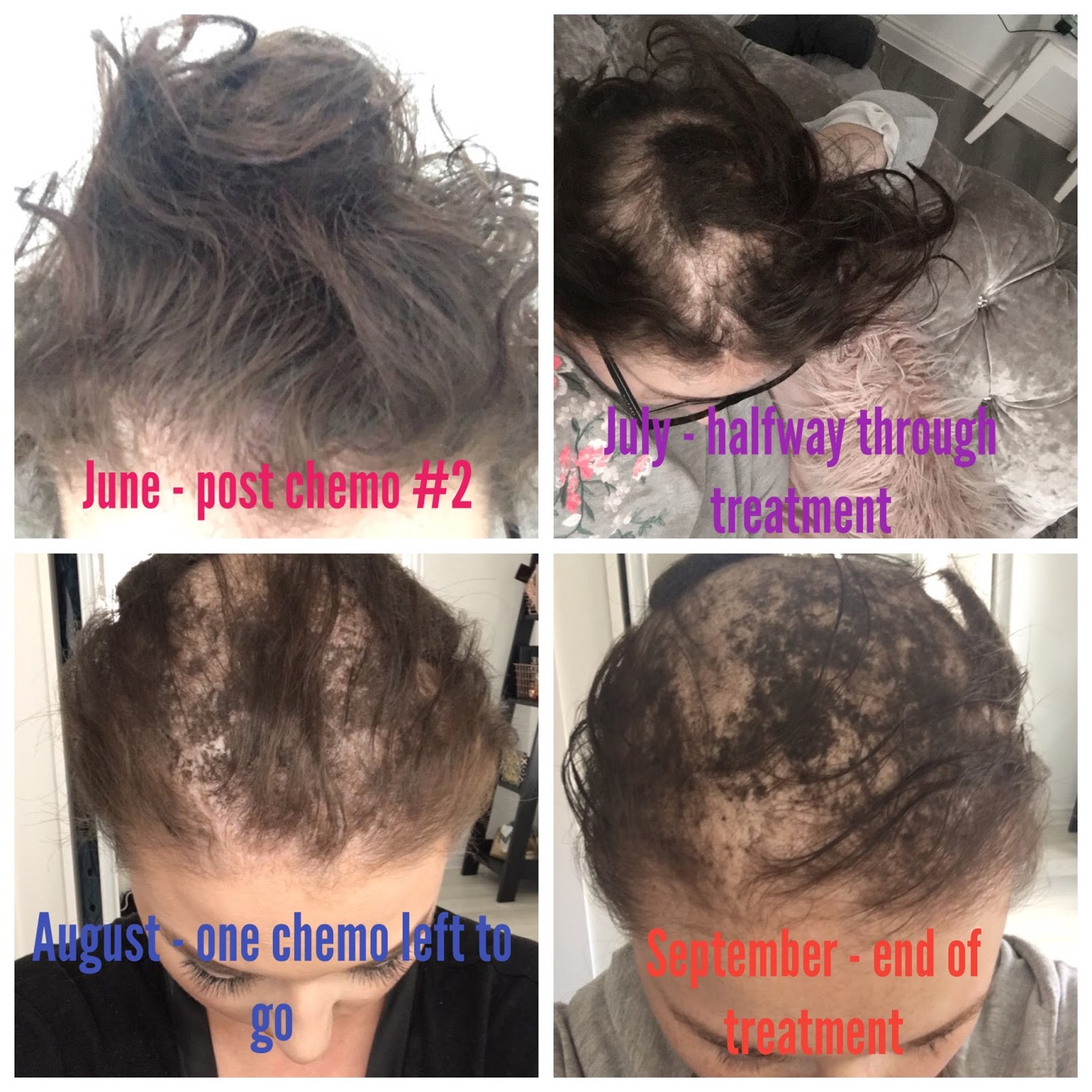 Abvd Chemotherapy Hair Loss What Lauren Did Next