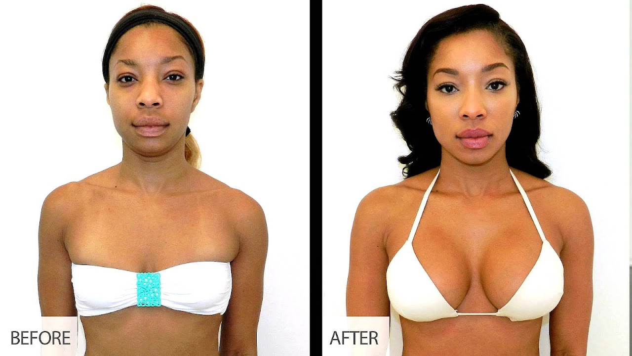 Before And After Breast Lift And Augmentation Photos. author profile. 