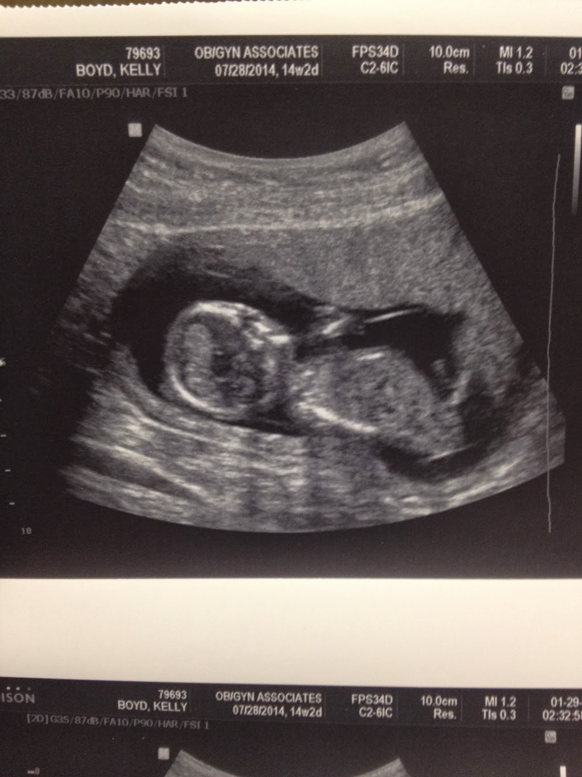 Baby At 14 Weeks Ultrasound Gender Get More Anythink's