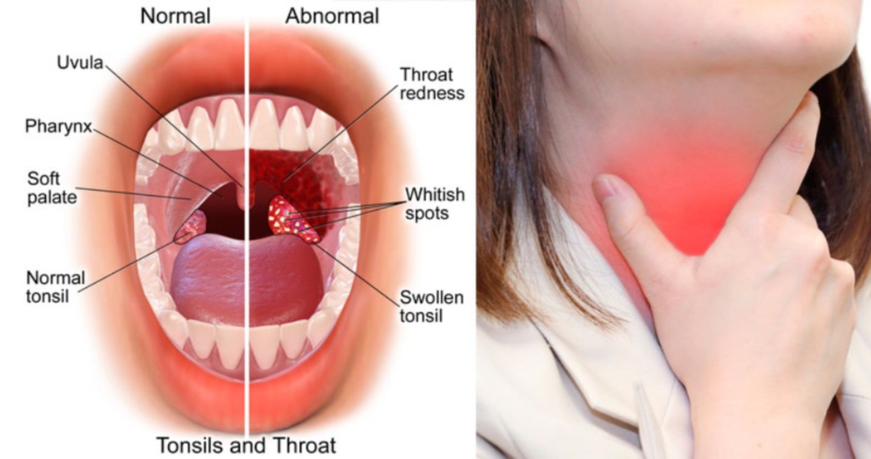 Tonsil Boleh Membawa Maut Jika Tidak Di Rawat