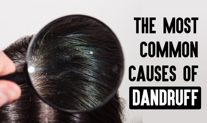 What are The Most Common Causes Of Dandruff