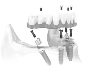 Quy trình lắp cầu răng sứ-1