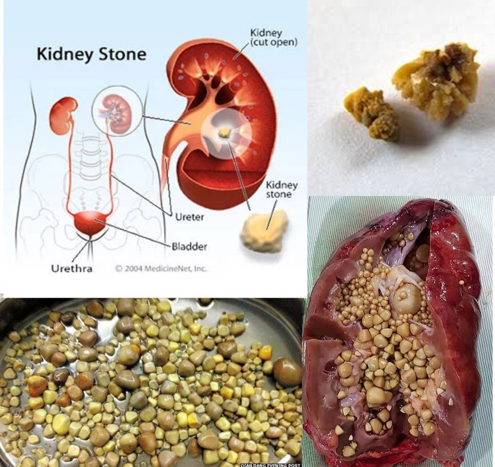 Strong And Beyond How To Flush Kidney Stones Naturally With Just Four 