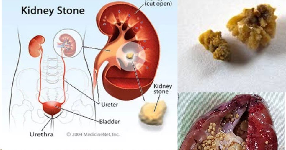 Strong and Beyond How to Flush Kidney Stones Naturally With Just Four