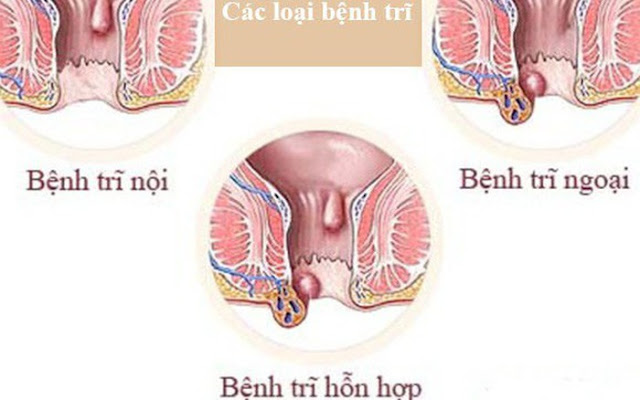 Phân loại trĩ theo từng loại và cấp độ