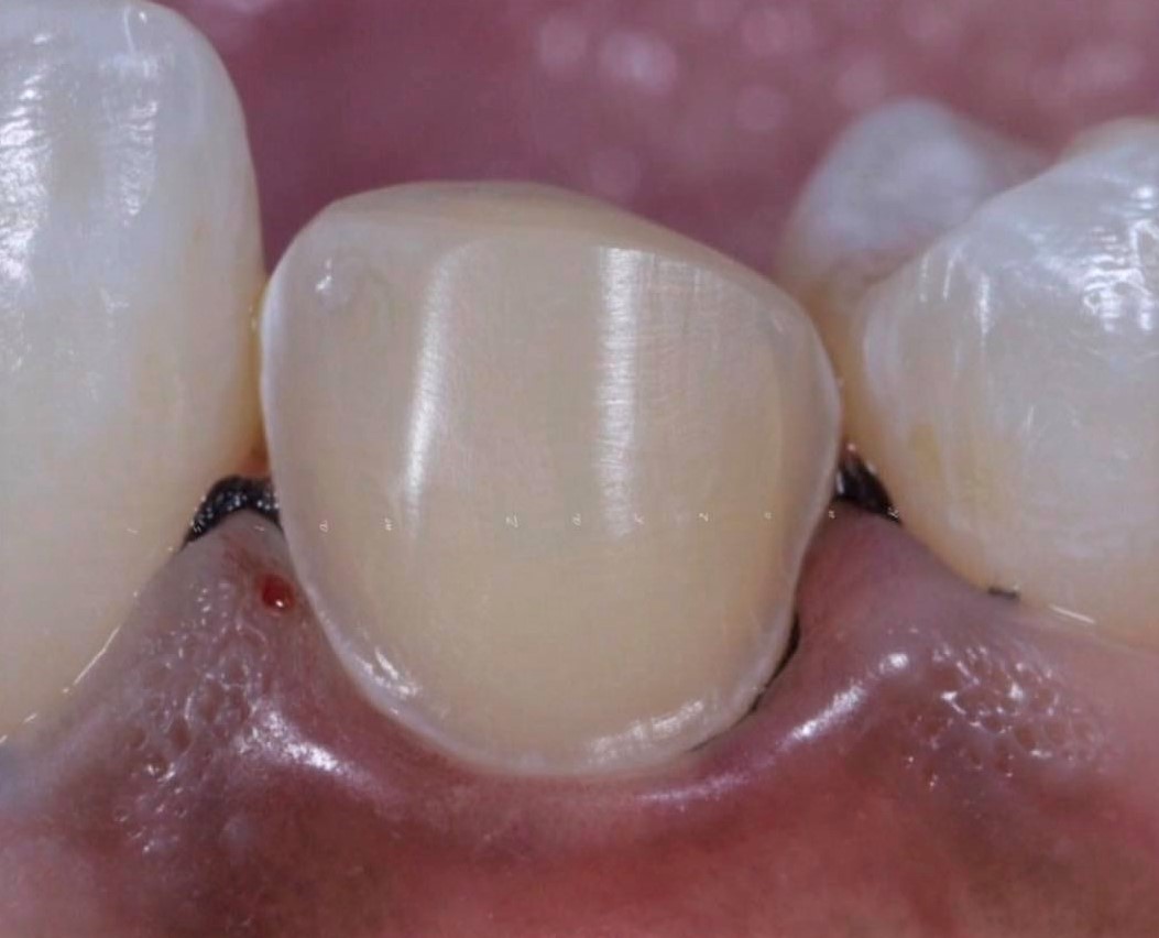 Ceramic veneers preparartion .. Part 2 " Conventional preparation