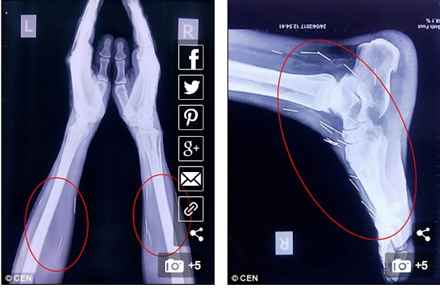 Hasil X-ray menemukan banyak jarum di tubuh