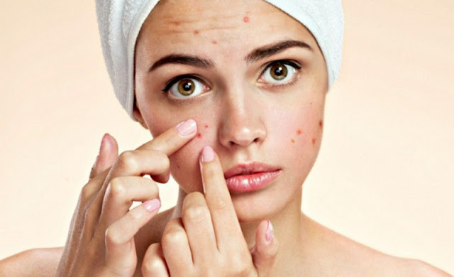 Cara Menghilangkan Bekas Jerawat dengan Mudah, Cepat dan Alami Cara Menghilangkan Bekas Jerawat dengan Mudah, Cepat dan Alami