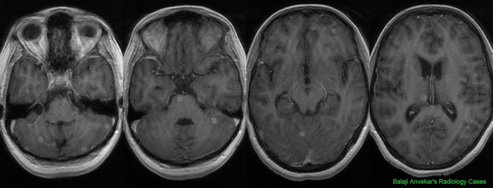 Dr Balaji Anvekar's Neuroradiology Cases: 01/09/11 - 01/10/11