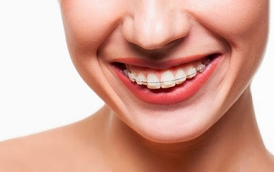 Niềng răng khi mất răng 6 có cần nhổ răng không? 2
