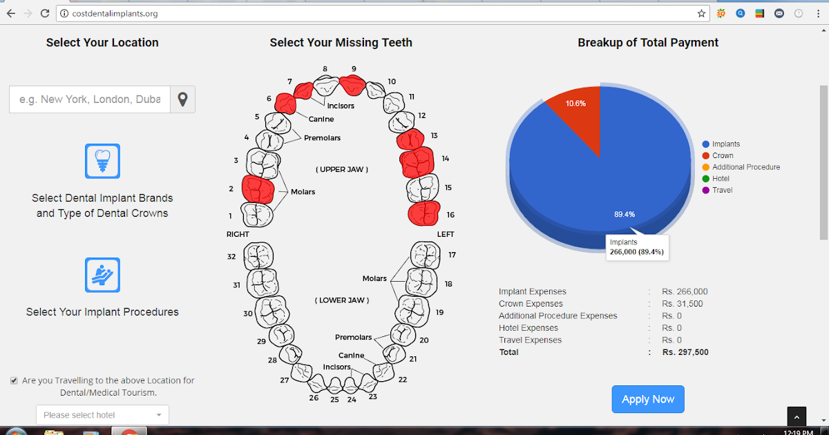 Calculator for Dental Implant Treatment
