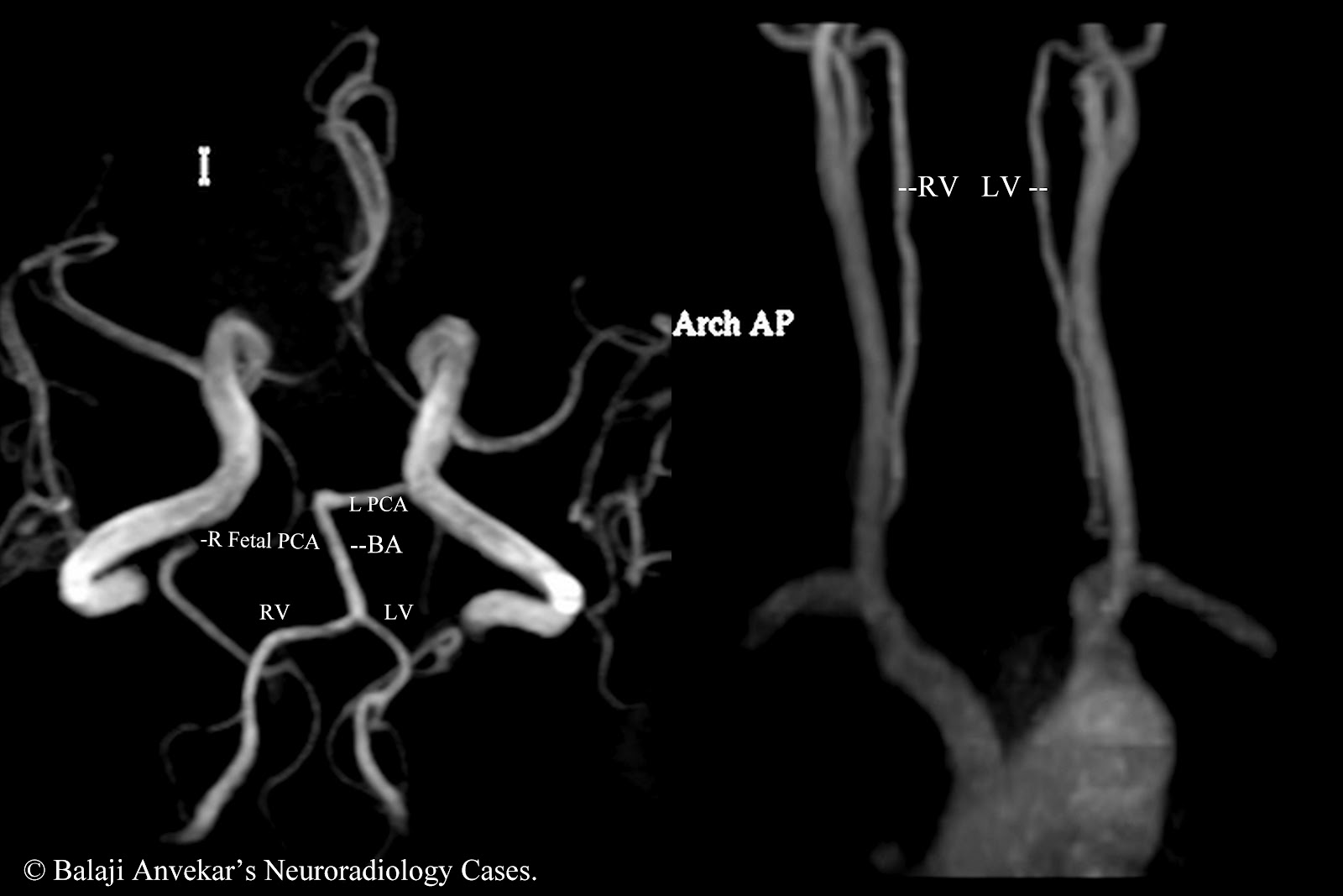 Гипоплазия правой головного мозга. Глоссарий Radiology. Basilar artery infarction MRI. Vertebral Vein Imaging with Mr Angiography.