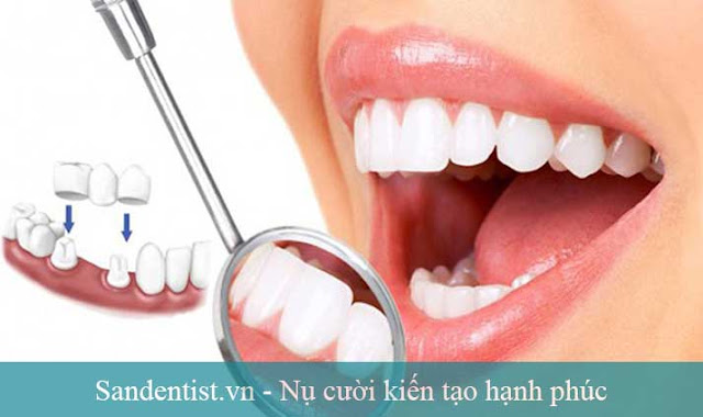 Kinh nghiệm, quy trình bọc răng sứ với 5 bước đơn giản