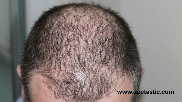 Hair Fall - Diagnosis and treatment - treatment for preventing falling hair