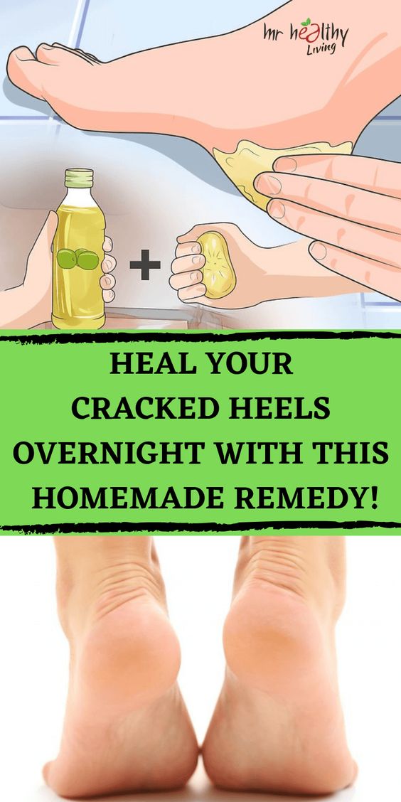 Say Stop To Your Cracked Heels With This Amazing Homemade Remedy Wellness Days