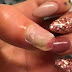CONTENU CHOC: Une femme risque de perdre son pouce à cause de ses faux ongles.