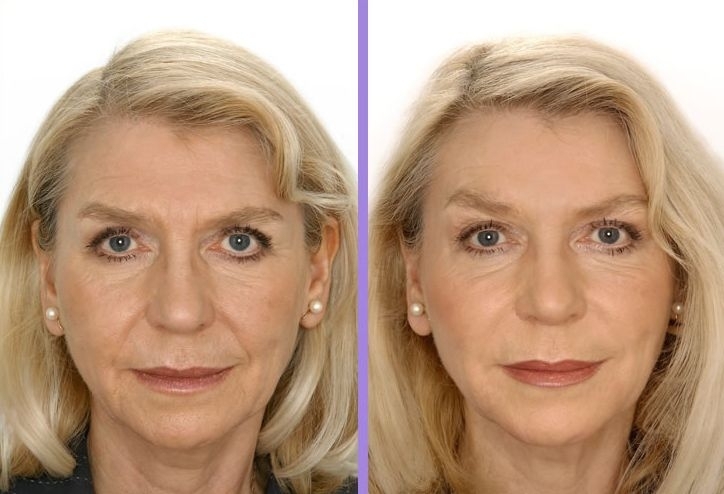 Филлер человек. Филлеры до и после. Ботокс для лица до и после. Контурная пластика лица. Филеры в косметологии.