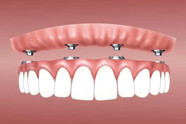 animated picture of All on 4 dental implants