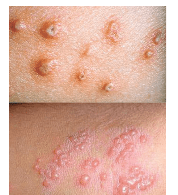 Herpes Zoster (Shingles) - Causes, Symptoms, Treatment, and Prevention