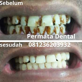 gambar foto sebelum dan sesudah scalling bersihkan karang gigi sisa rokok nikotin gigi kuning gigi kotor bekas kopi plak gigi noda gigi flek bercak pada gigi  