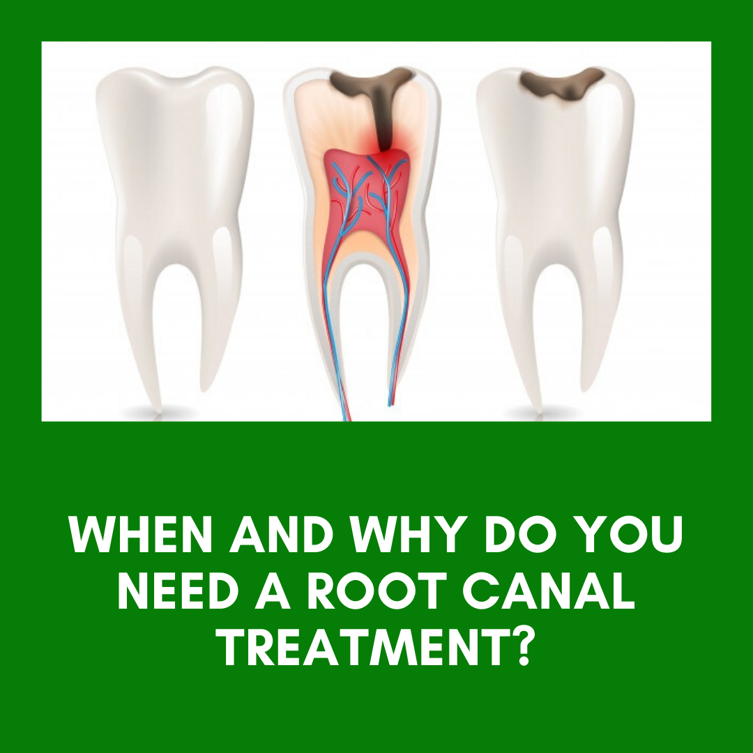 Collection 98+ Images Pictures Of Teeth That Need Root Canals Completed 12/2023