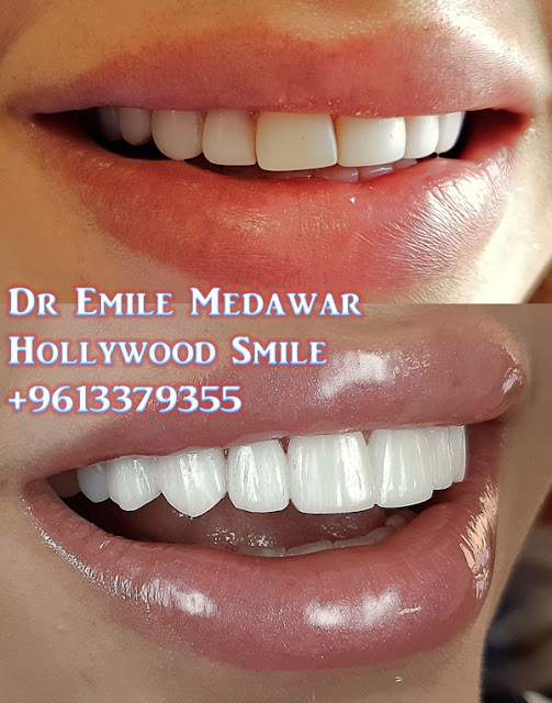 EMax Veneer, Dr Emile Medawar, 00 961 3 379355 Porcelain Veneers, E