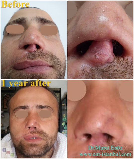 Complicated Revision Rhinoplasty, Revision Nose Job For Male, 8th Nose Operation