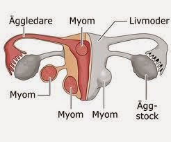 http://sayherbal.blogspot.com/2015/04/pengobatan-herbal-untuk-mioma-uteri.html