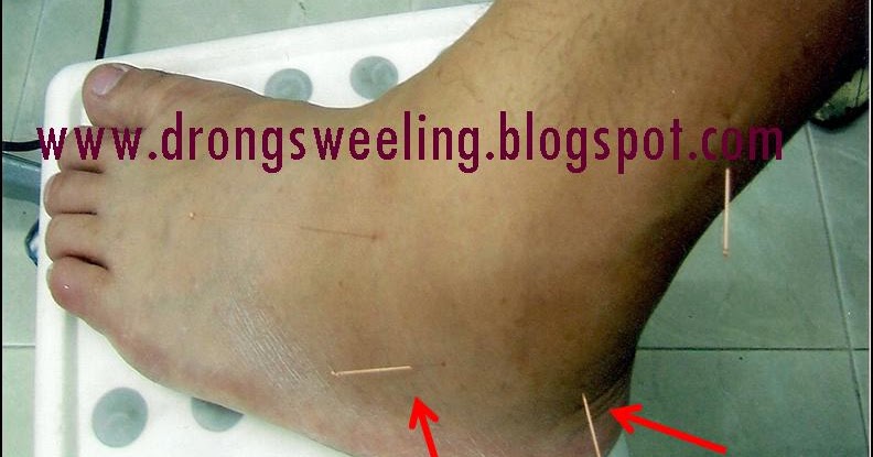 Tcm News Tcm Clinic Physician Treat Sprain Ankles Wrists Knee Pain