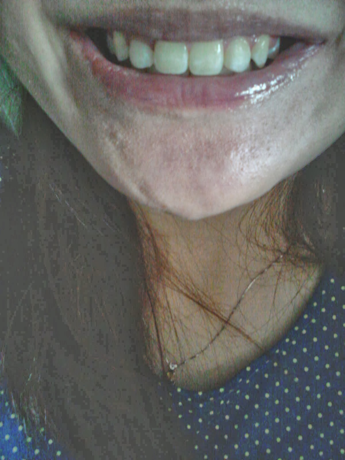 Jaslyn's blog My braces journey