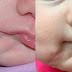 Bebê é submetida a cirurgia após nascer com duas bocas