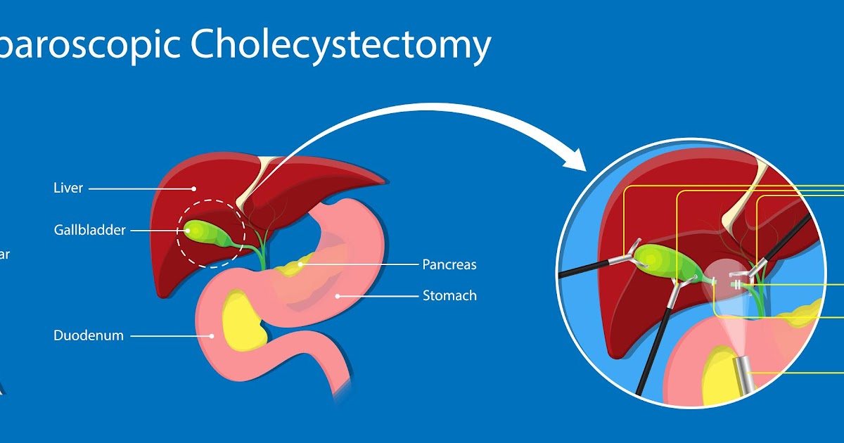 Real Psychiatry The Laparoscopic Cholecystectomy