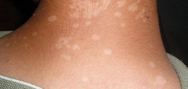 كيفية الوقاية من الإصابة بالتنيا الملونة؟ كيفية الوقاية من الإصابة بالتنيا الملونة؟