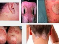 Testimoni Obat Gatal De Nature Indonesia Testimoni Obat Gatal De Nature Indonesia