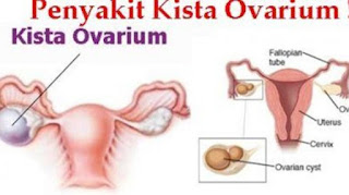 obat kista ovarium de nature
