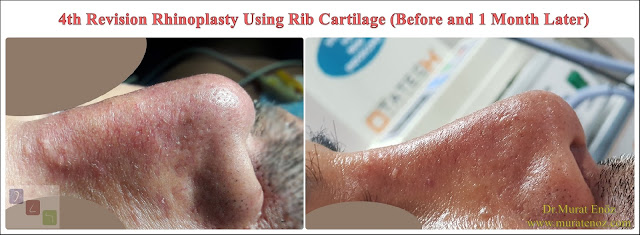 Revision Rhinoplasty in Istanbul - 4th Revision Rhinoplasty Using Rib Cartilage