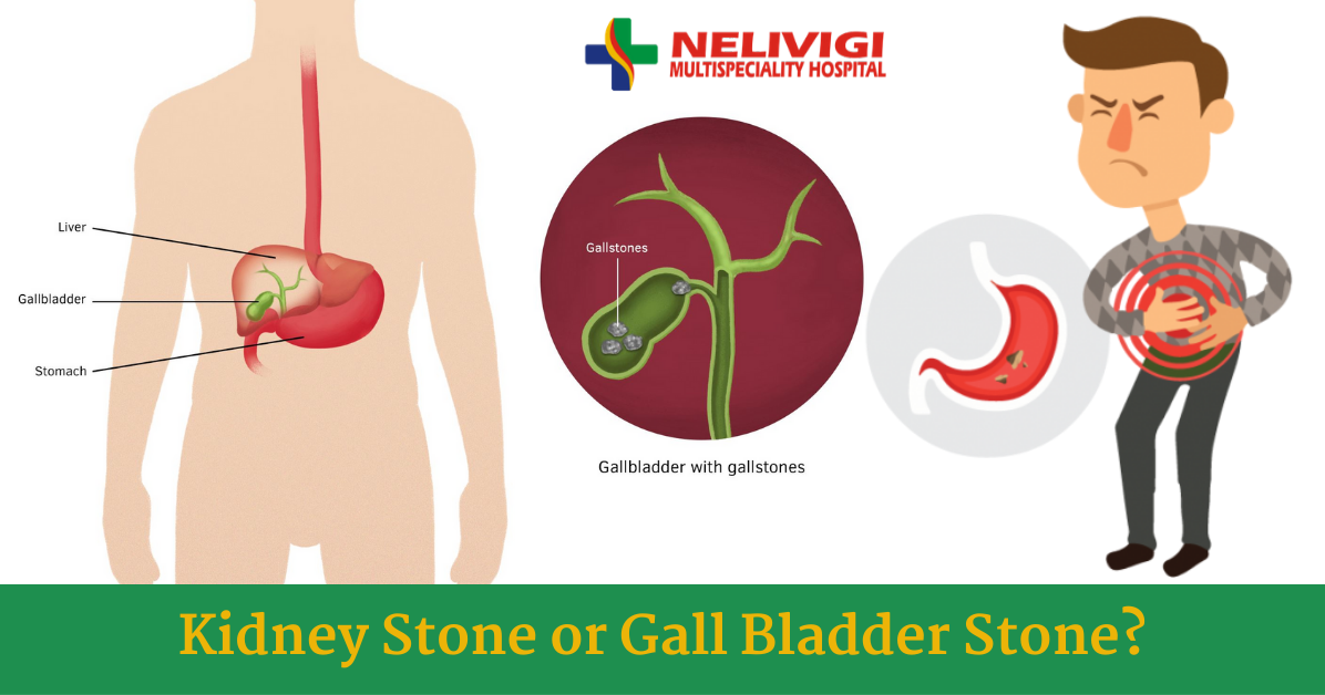 Kidney Stone Or Gall Bladder Stone?