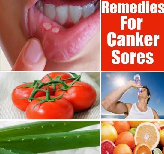 Home Remedies For Canker Sores