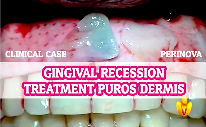 GINGIVAL RECESSION: Treatment with Puros Dermis - Clinical Case